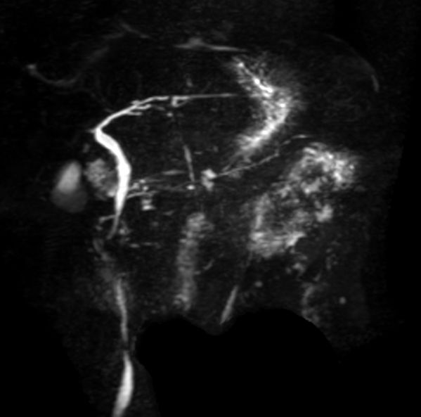 3D MRCP - Breath hold (MIP) <b>Compressed SENSE</b>