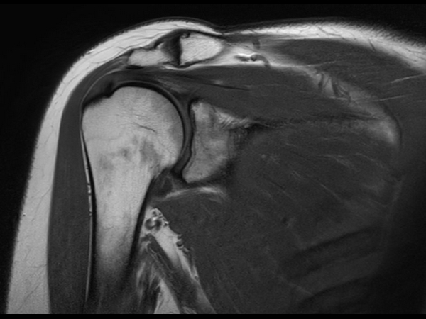 Coronal T1w TSE