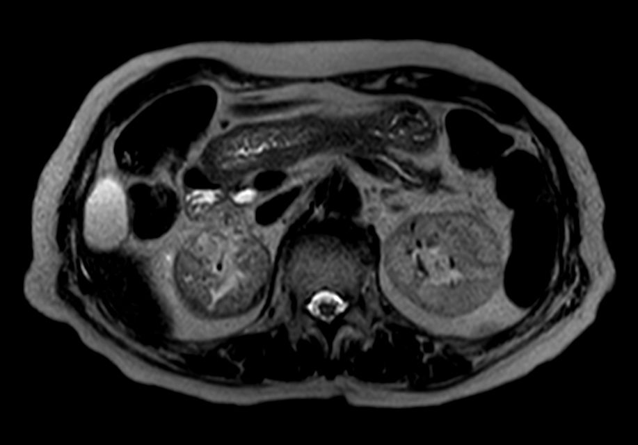 T2w TSE - Free Breathing