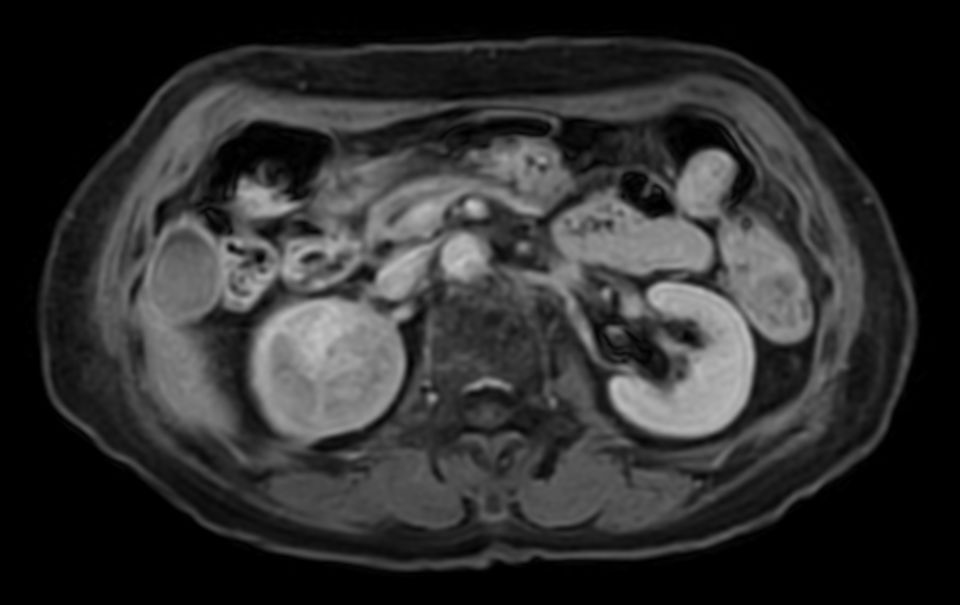 T1w FFE mDIXON XD (post-gado) - Breath hold