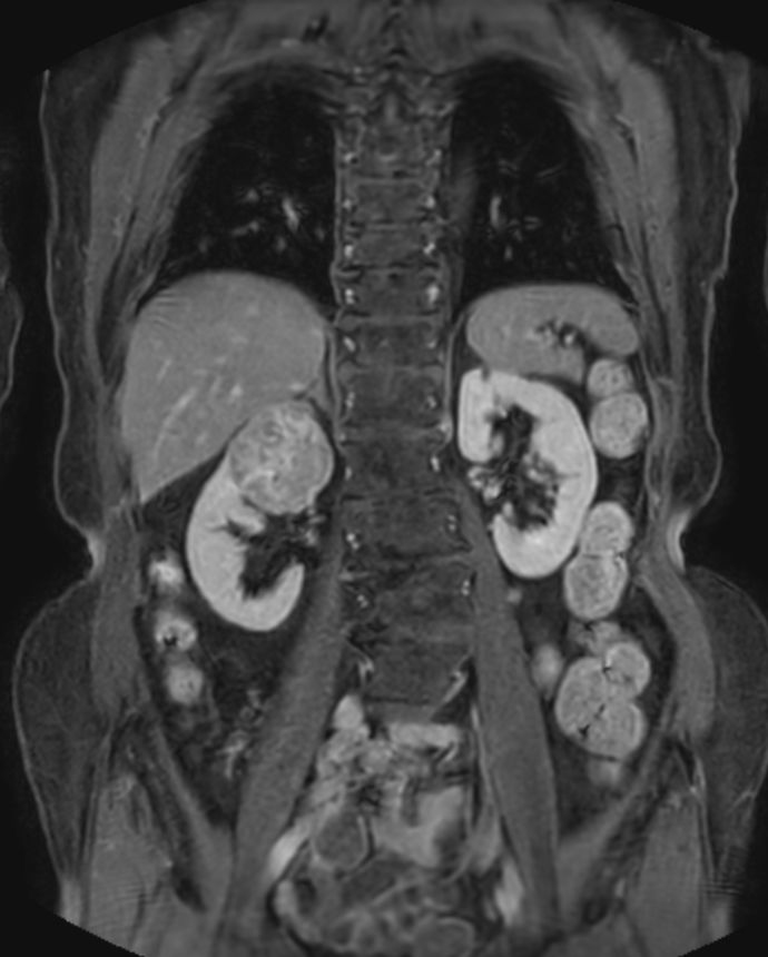 T1w FFE mDIXON XD (post-gado) - Breath hold