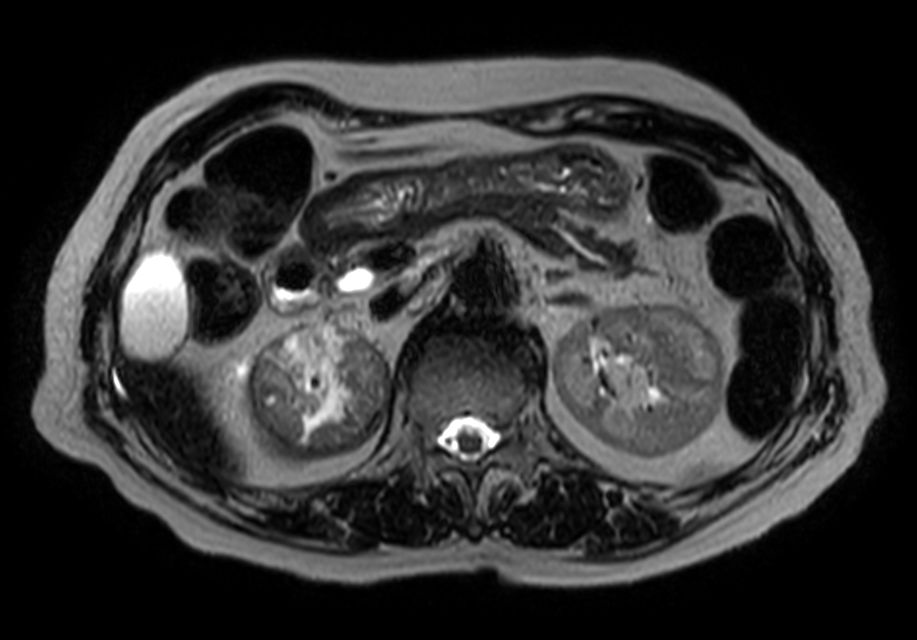 Heavy T2w TSE - Free Breathing