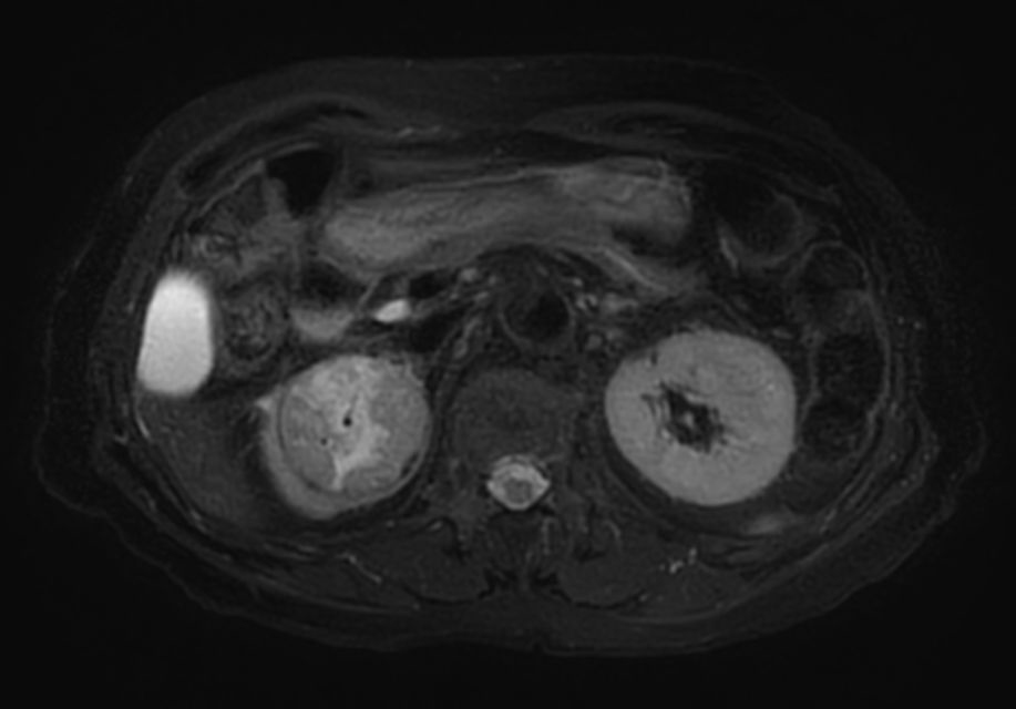 T2w SPIR MultiVane XD - Free Breathing