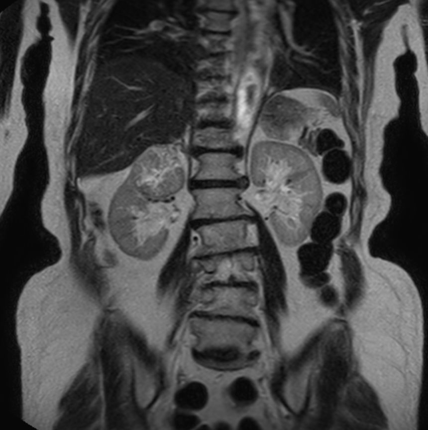 T2w TSE - Free Breathing (6 mm)