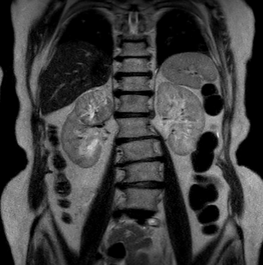T2w TSE - Free Breathing (4.5 mm)