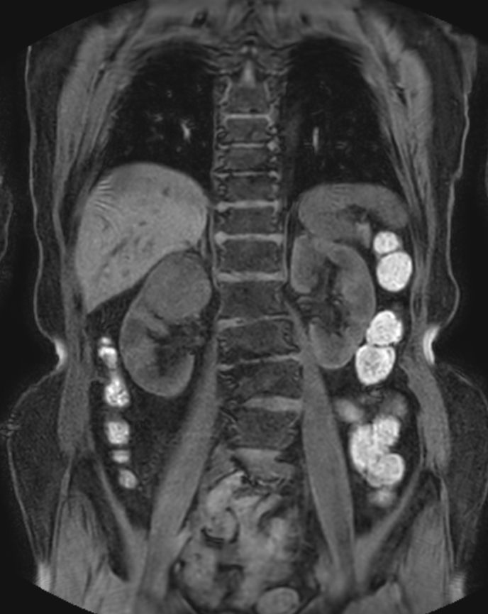 T1w FFE mDIXON XD - Breath hold