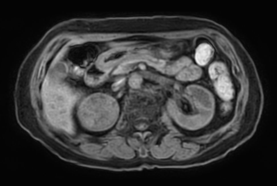 T1w FFE mDIXON XD - Breath hold