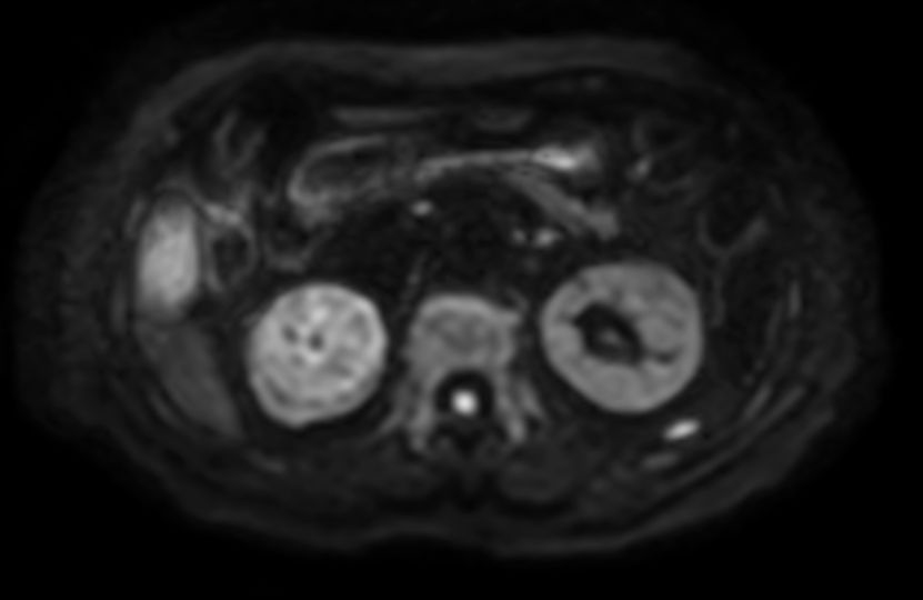 Diffusion b800 - Free Breathing