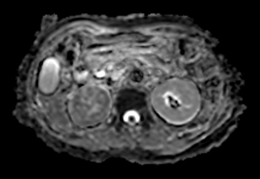 Diffusion b800 (ADC) - Free Breathing