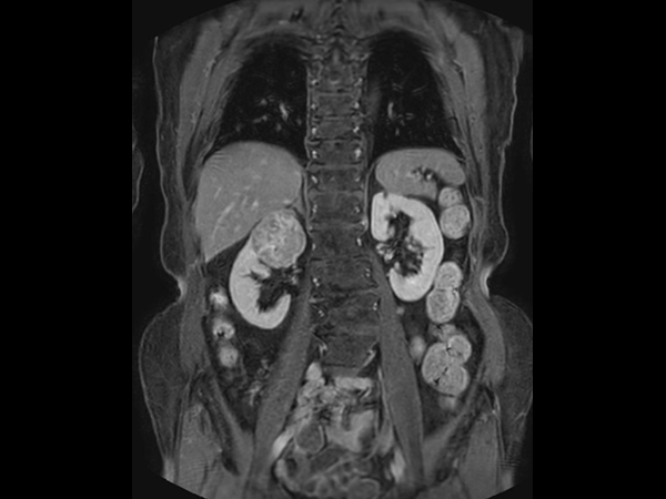 T1w FFE mDIXON XD (post-gado) - Breath hold