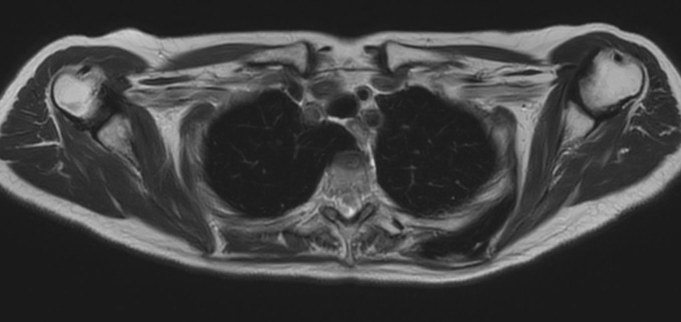 T2w TSE MultiVane XD - Free Breathing