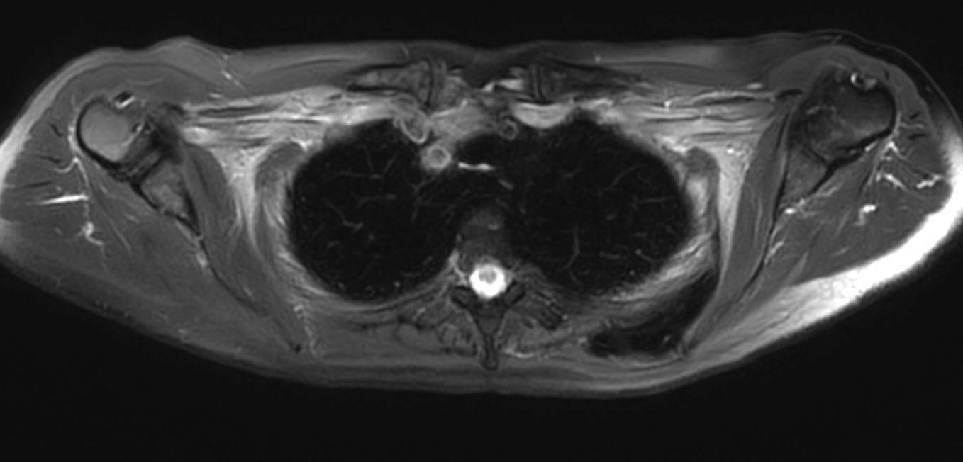 T2w SPIR MultiVane XD - Free Breathing