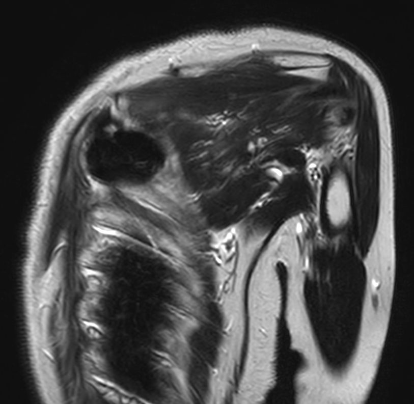 T2w TSE - Free Breathing <b>Compressed SENSE</b>