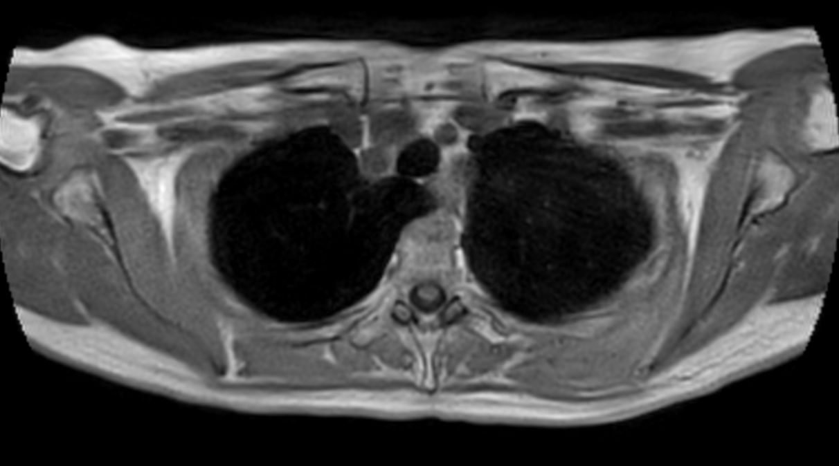 T1w FFE 3D VANE XD (In Phase) - Free Breathing