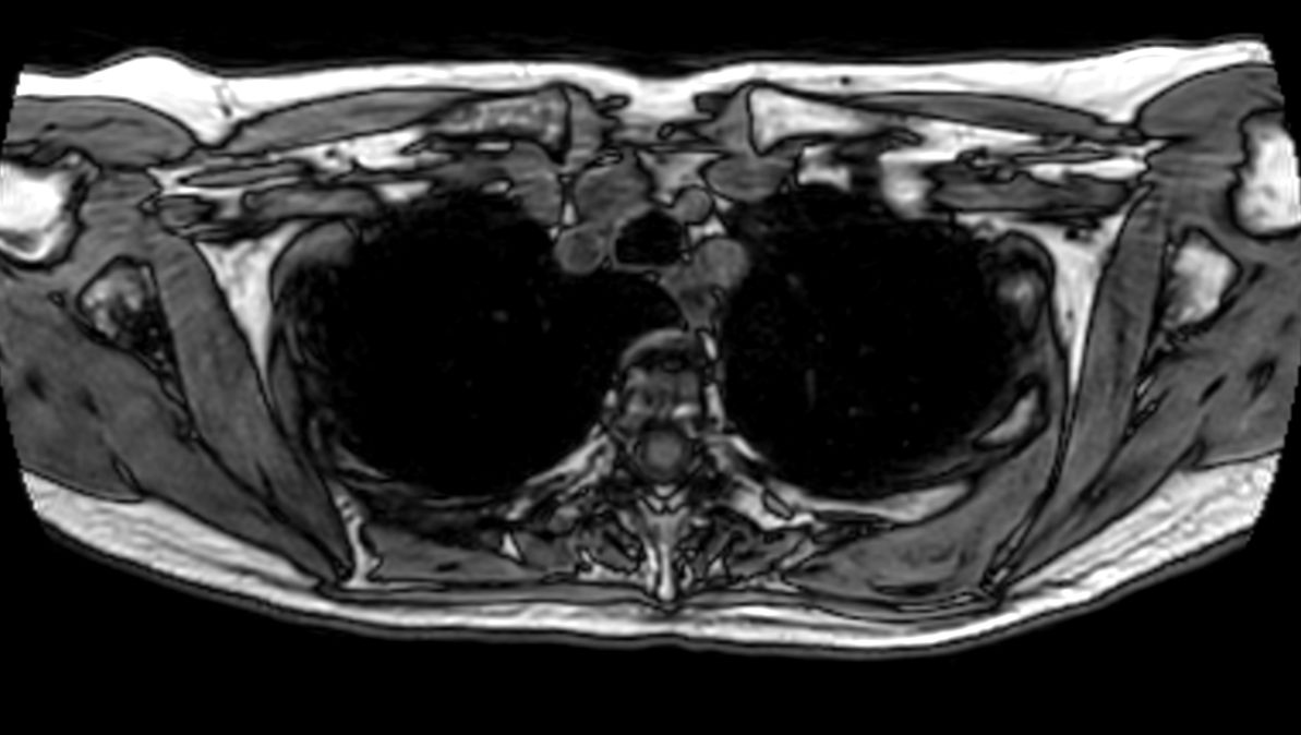 T1w FFE 3D VANE XD (Out Phase) - Free Breathing