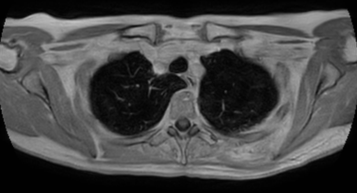 T1w FFE 3D VANE XD (In Phase) - Free Breathing (post-gado)