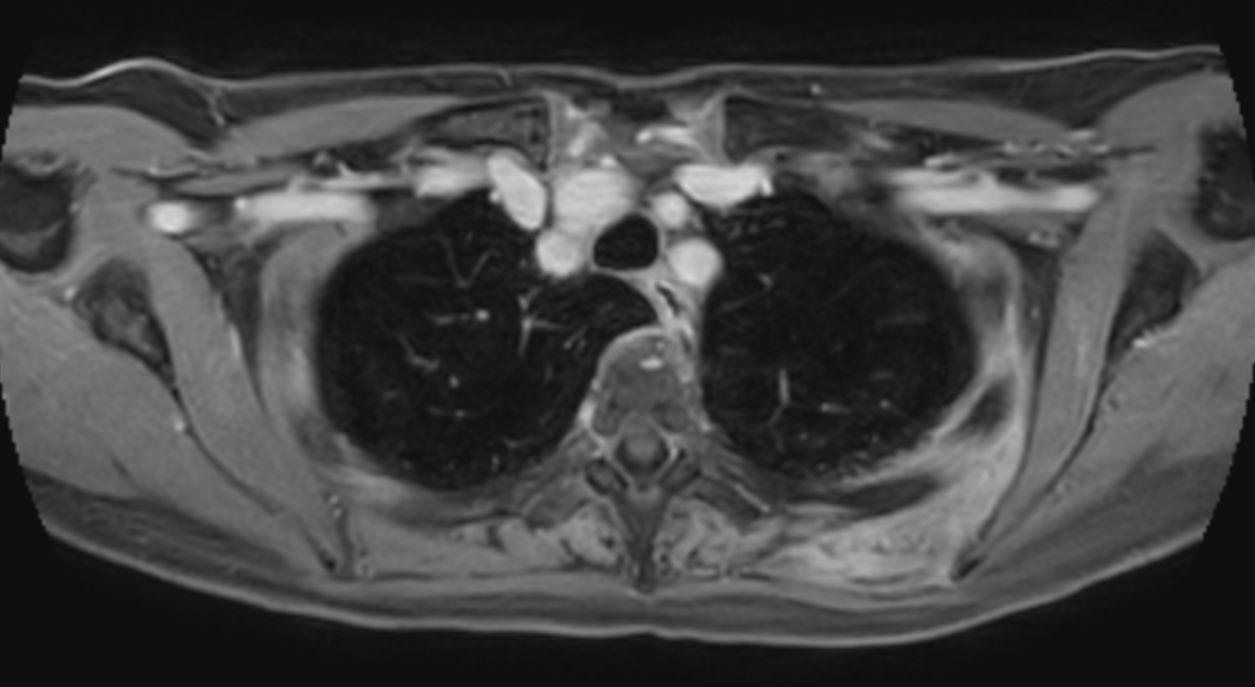 T1w FFE 3D VANE XD (Water only) - Free Breathing (post-gado)