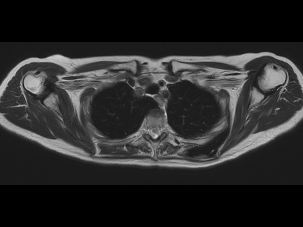 T2w TSE MultiVane XD - Free Breathing