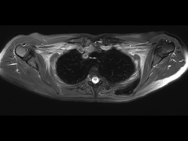 T2w SPIR MultiVane XD - Free Breathing