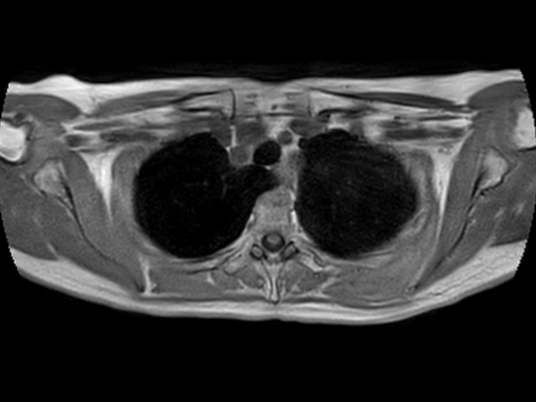 T1w FFE 3D VANE XD (In Phase) - Free Breathing