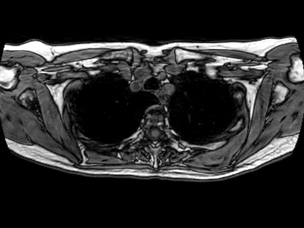 T1w FFE 3D VANE XD (Out Phase) - Free Breathing