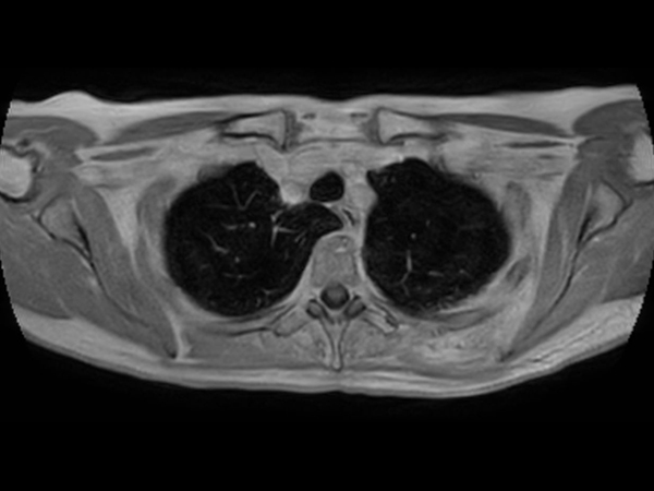 T1w FFE 3D VANE XD (In Phase) - Free Breathing (post-gado)