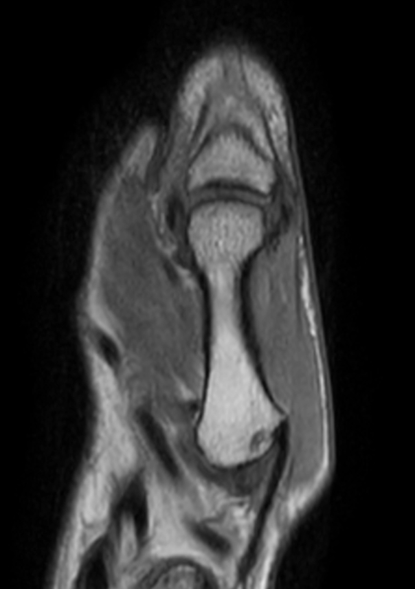 PDw TSE mDIXON XD (In Phase)