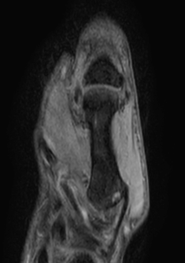 PDw TSE mDIXON XD (Water only)