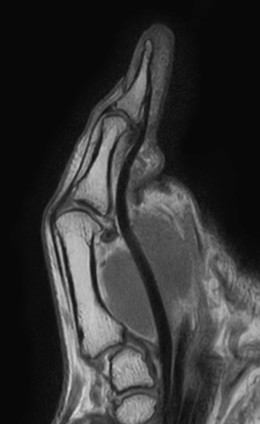 PDw TSE mDIXON XD (In Phase)