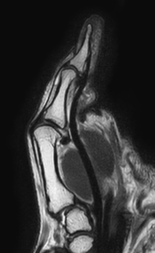 T2w TSE mDIXON XD (In Phase)