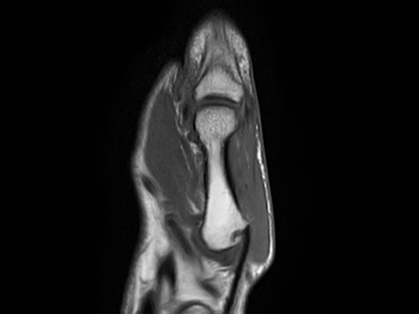 Coronal T1w TSE