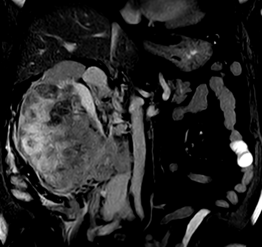 bTFE - VitalEye <b>Compressed SENSE</b>