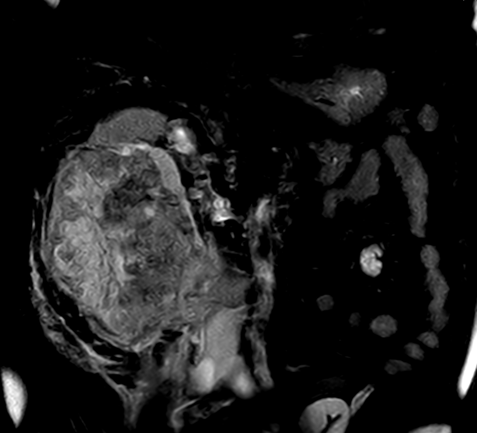 T2w SPAIR - VitalEye <b>Compressed SENSE</b>