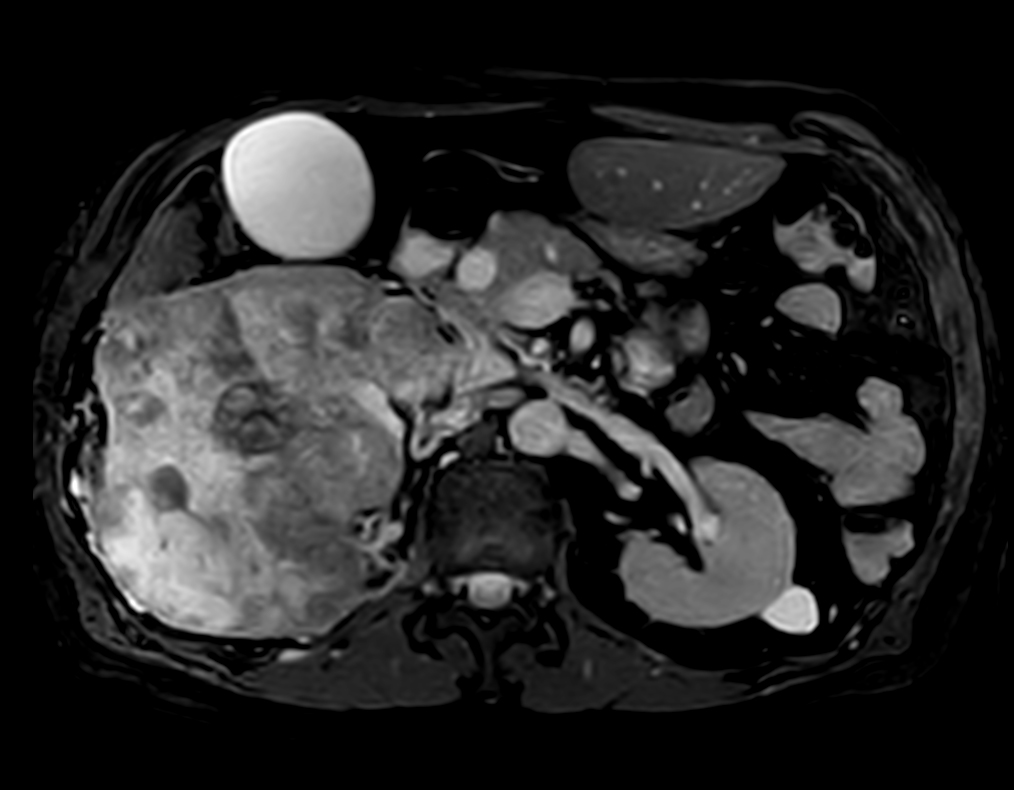 bTFE - VitalEye <b>Compressed SENSE</b>