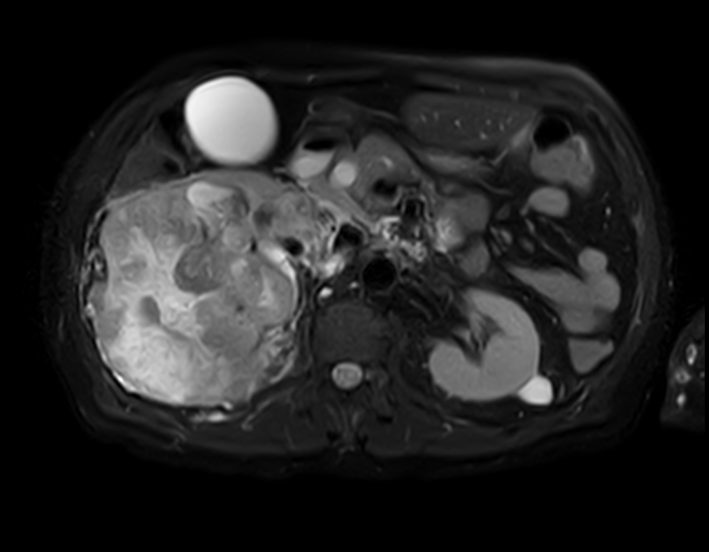 T2w SPAIR - VitalEye <b>Compressed SENSE</b>