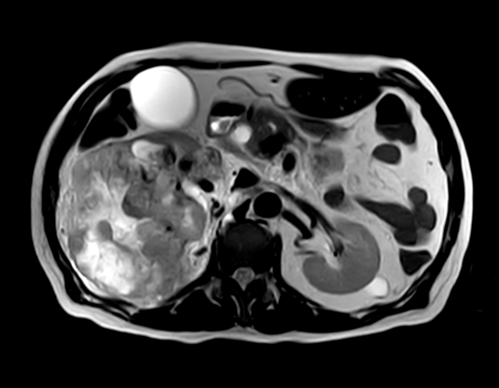 T2w TSE - VitalEye <b>Compressed SENSE</b>