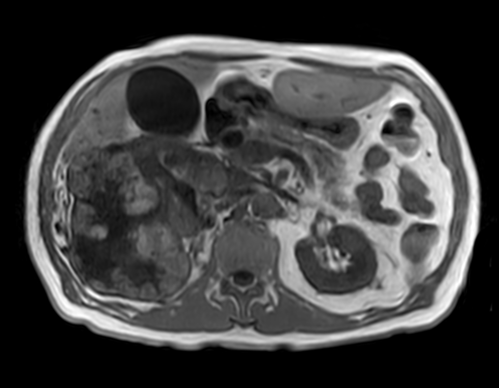 T1w FFE mDIXON XD (In Phase) <b>Compressed SENSE</b>