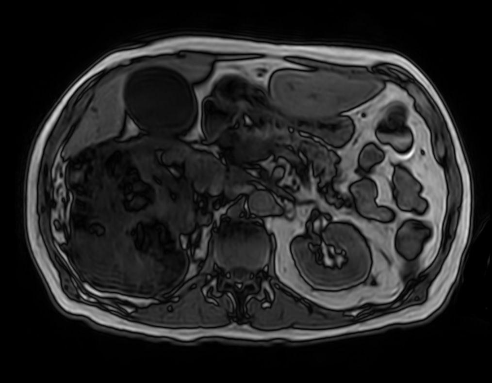 T1w FFE mDIXON XD (Out Phase) <b>Compressed SENSE</b>