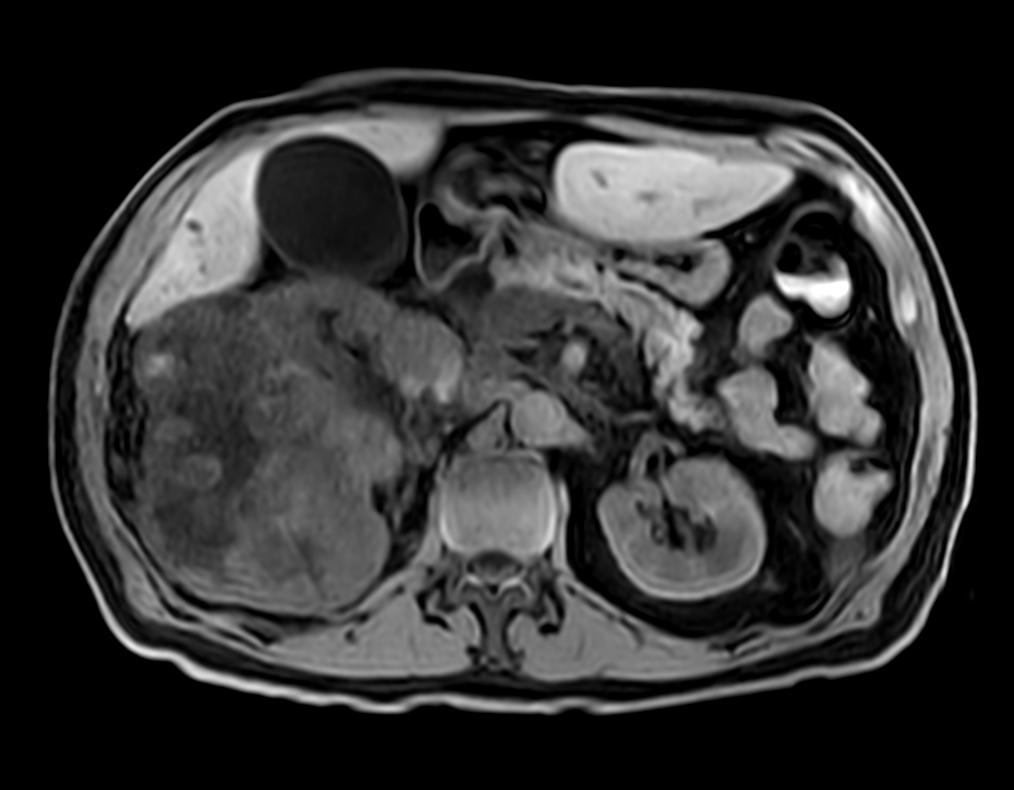 T1w FFE mDIXON XD (Water only) <b>Compressed SENSE</b>