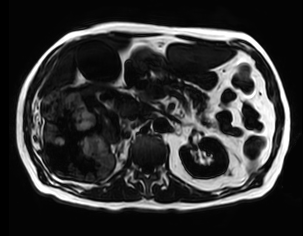 T1w FFE mDIXON XD (Fat only) <b>Compressed SENSE</b>
