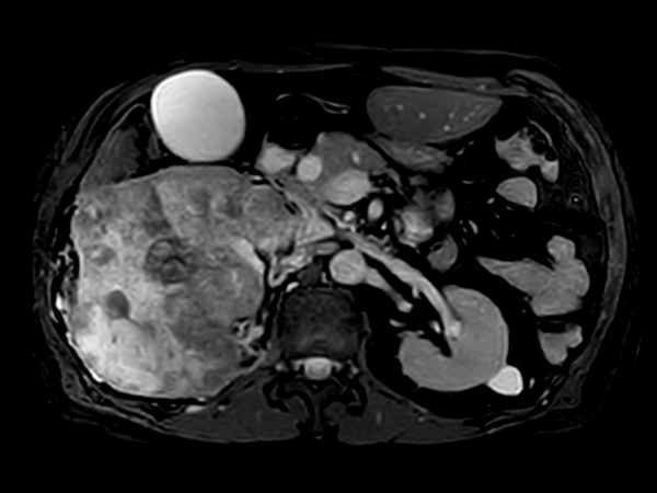 bTFE - VitalEye <b>Compressed SENSE</b>