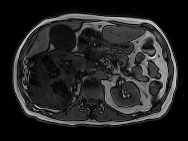 T1w FFE mDIXON XD (Out Phase) <b>Compressed SENSE</b>