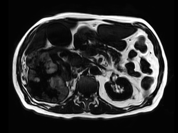 T1w FFE mDIXON XD (Fat only) <b>Compressed SENSE</b>