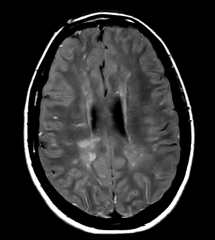 PDw TSE <b>Compressed SENSE</b>