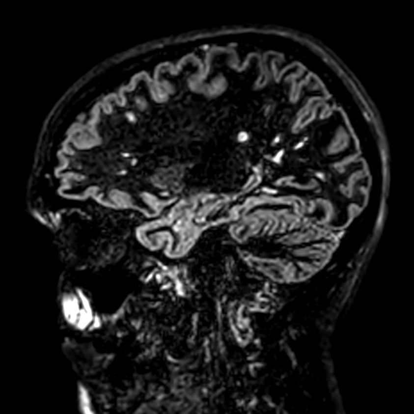 3D Double IR <b>Compressed SENSE</b>