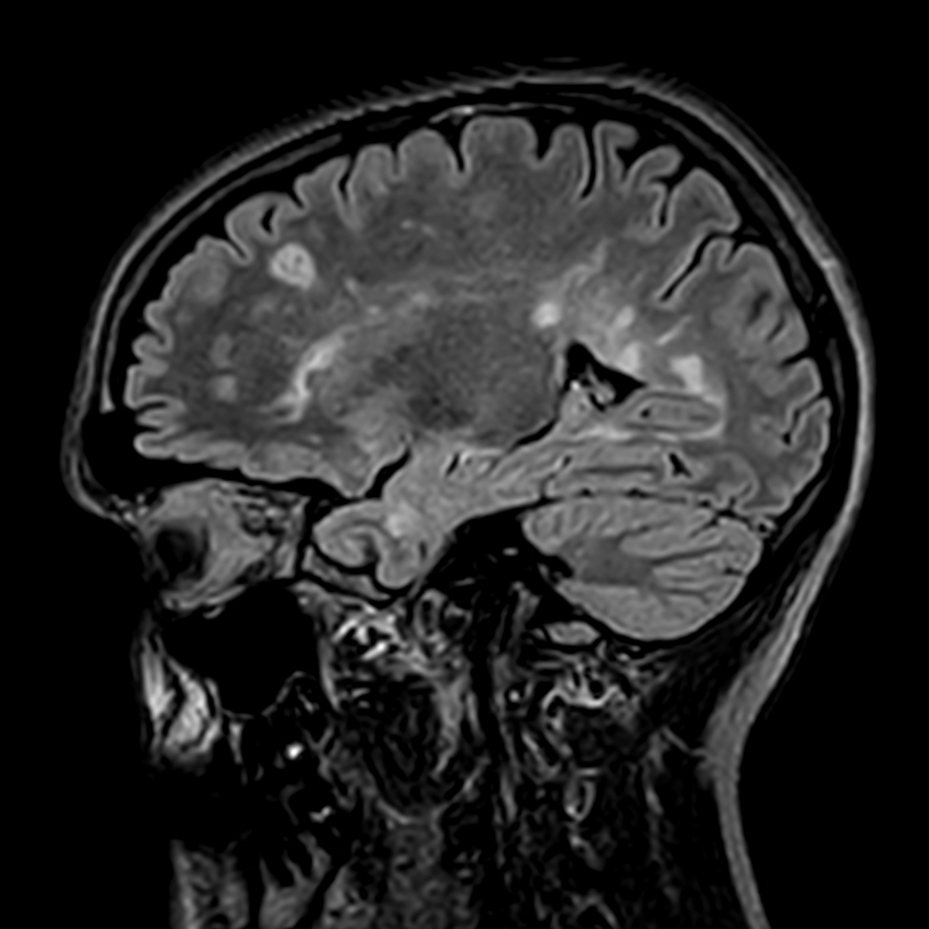 3D T2w FLAIR <b>Compressed SENSE</b>
