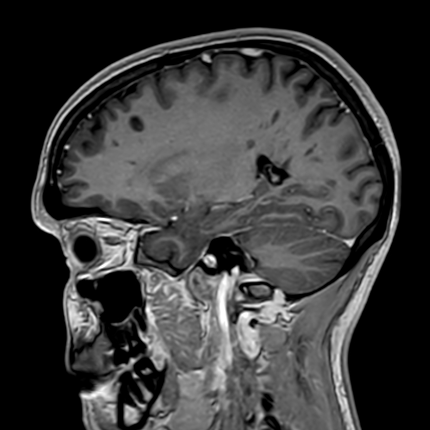 3D T1w FFE with gado <b>Compressed SENSE</b>