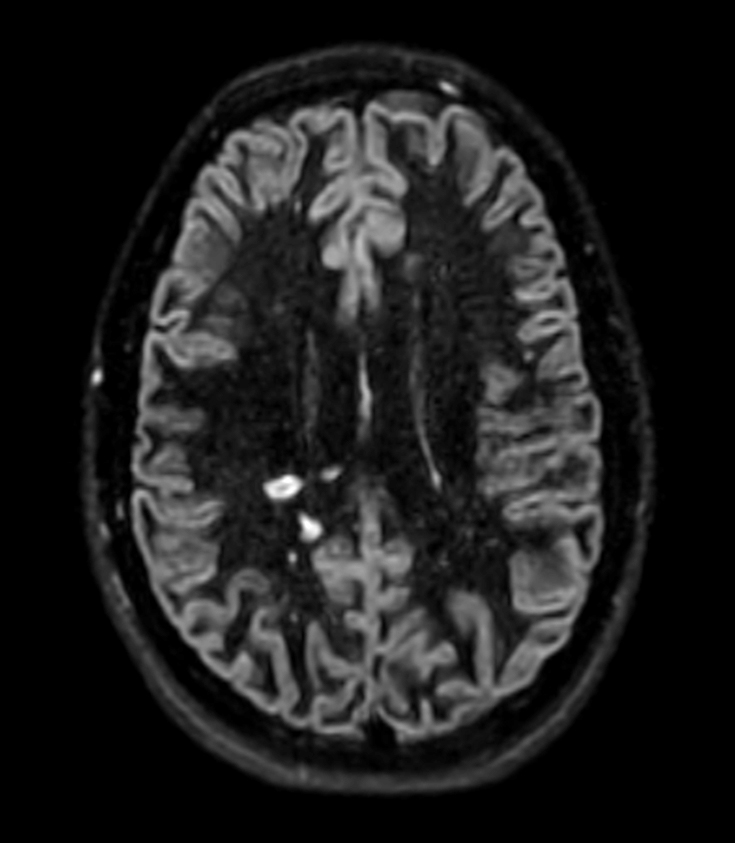 3D Double IR (Reformat) <b>Compressed SENSE</b>