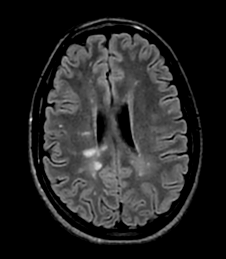 3D T2w FLAIR (Reformat) <b>Compressed SENSE</b>