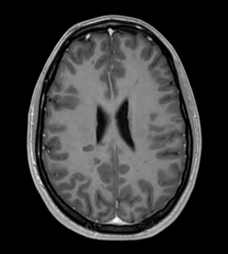 3D T1w FFE with gado (Reformat) <b>Compressed SENSE</b>